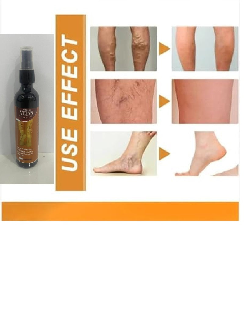 Varicose Veins Spray