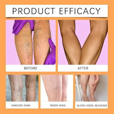 Varicose Veins Spray