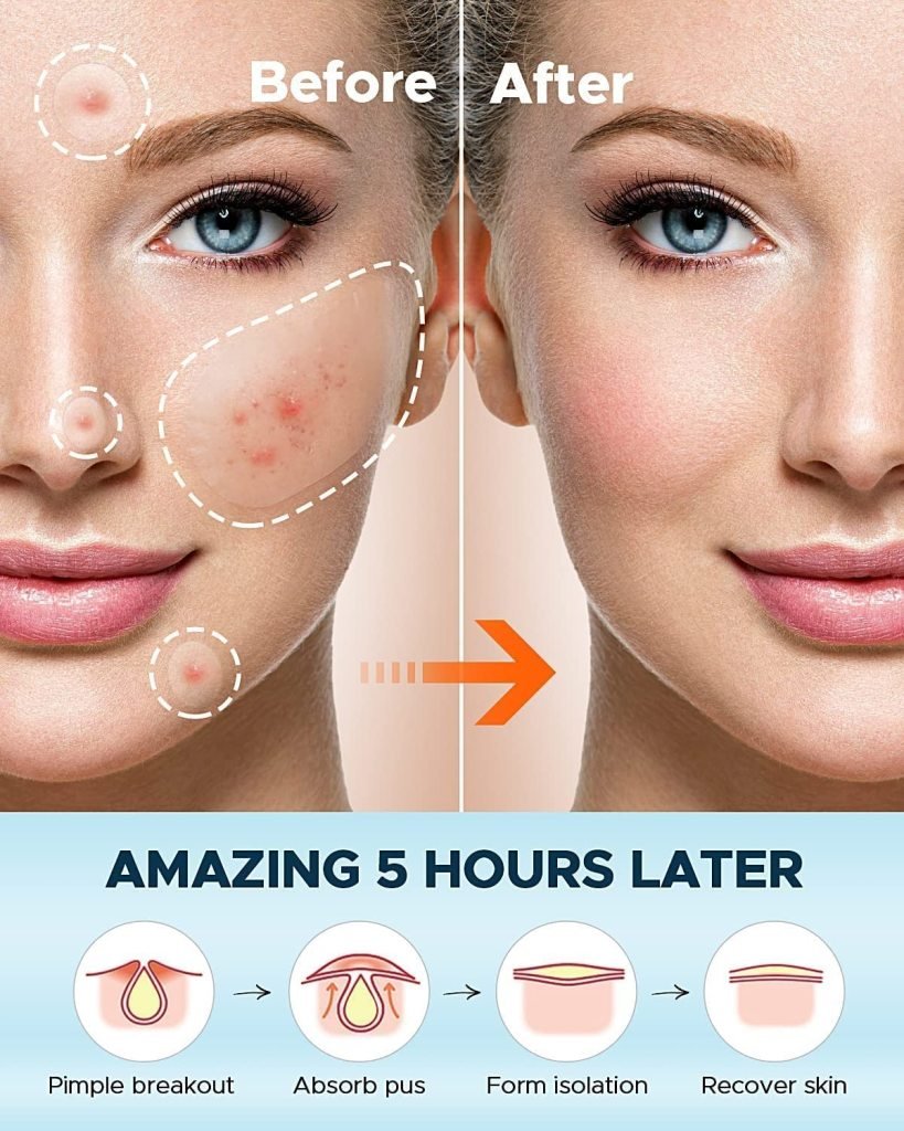 Acne Pimple Patch (36 Pcs)